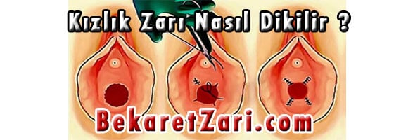 kızlık zarı nasıl dikilir